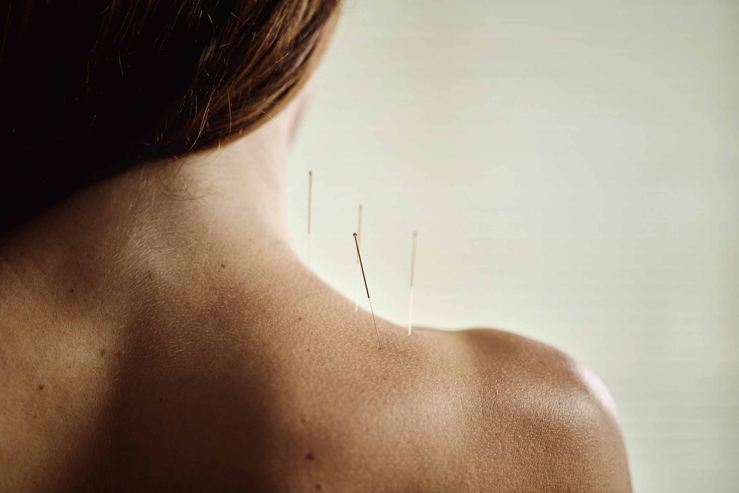 Acupuncture Encino