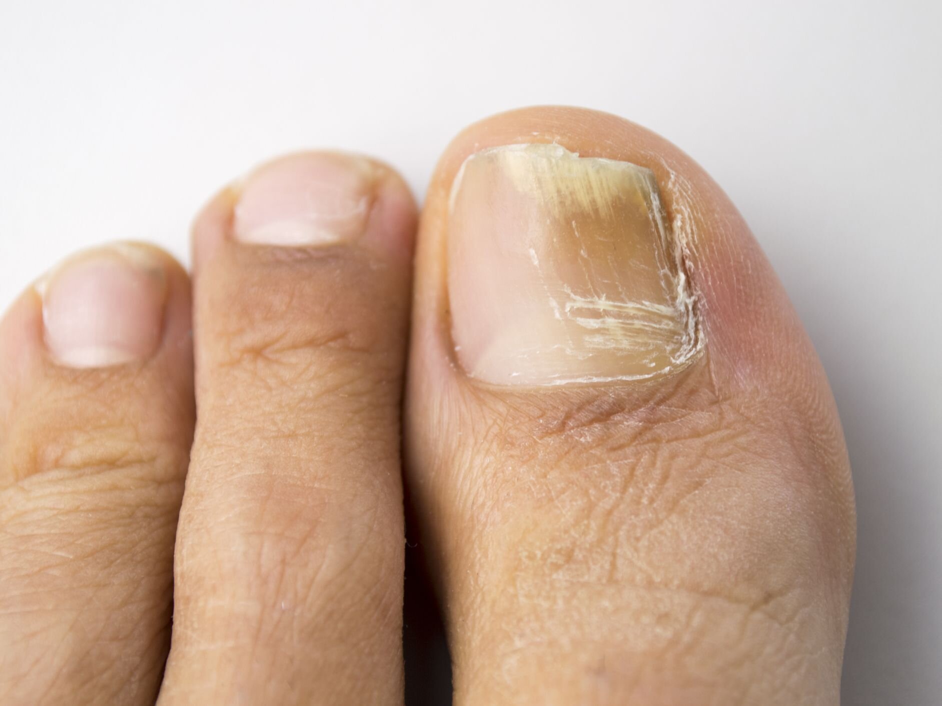 Fungal Nail Infection: Causes, Symptoms And Treatment