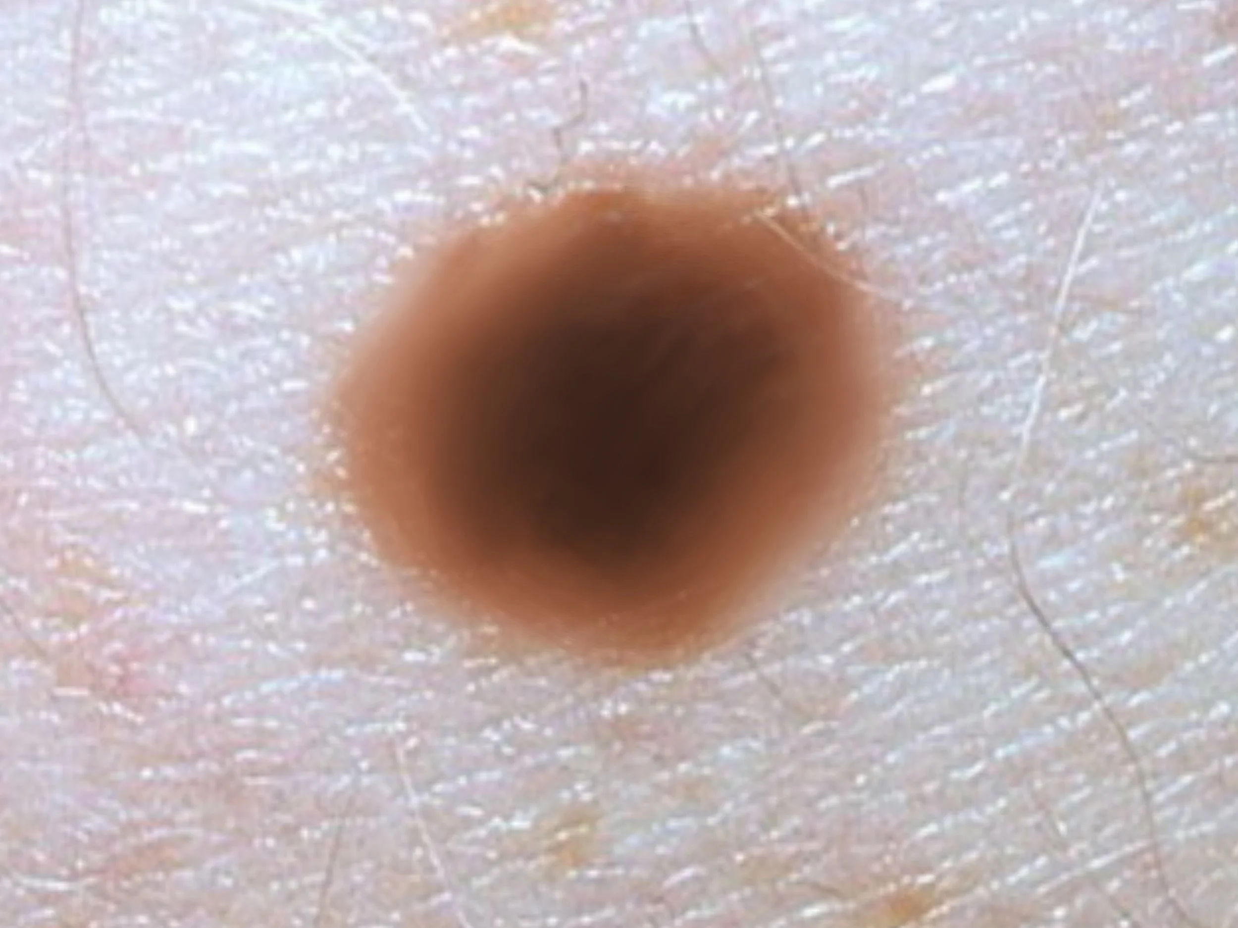 D is for Diameter: Congenital moles (present from birth) may naturally be larger than 6mm but for acquired moles we start to look at those larger than 6mm with more suspicion.