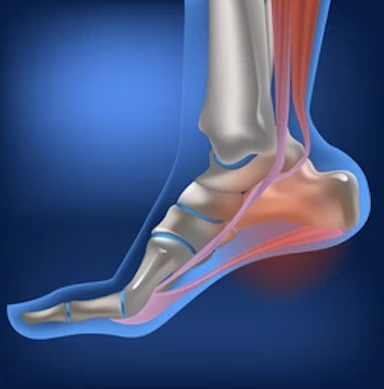 Anatomical graphic of foot biomechanics showing plantar fasciitis and heel pain treated at Indy Spine and Rehab in Carmel, Indiana.