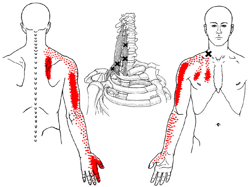 What is a Trigger Point? — Indy Spine and Rehab