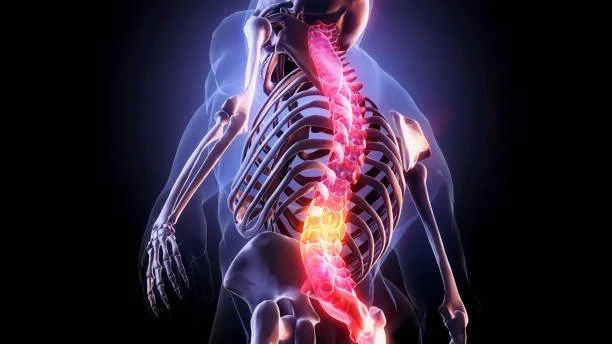 Anatomical graphic of the lumbar spine showing a disc herniation, treated at Indy Spine and Rehab in Carmel, IN.