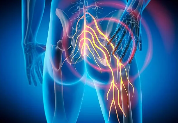 Anatomical graphic of the lower back and pelvis highlighting sciatic nerve irritation treated at Indy Spine and Rehab in Carmel, Indiana.