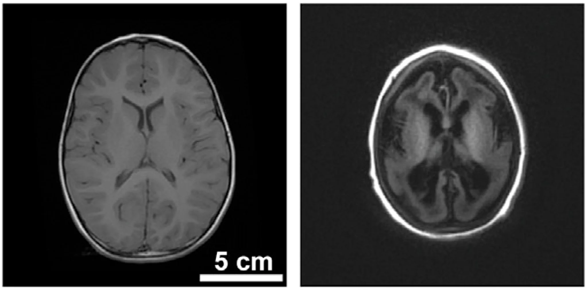 Mutations in a tRNA synthetase causes brain malformation (2014)