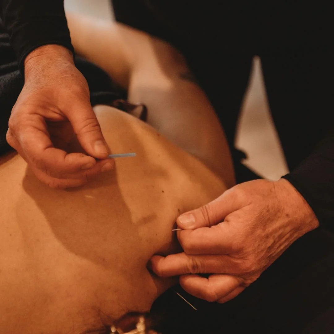 Traditional Chinese Medicine (TCM) Treatment for Myofascial Trigger Point Pain