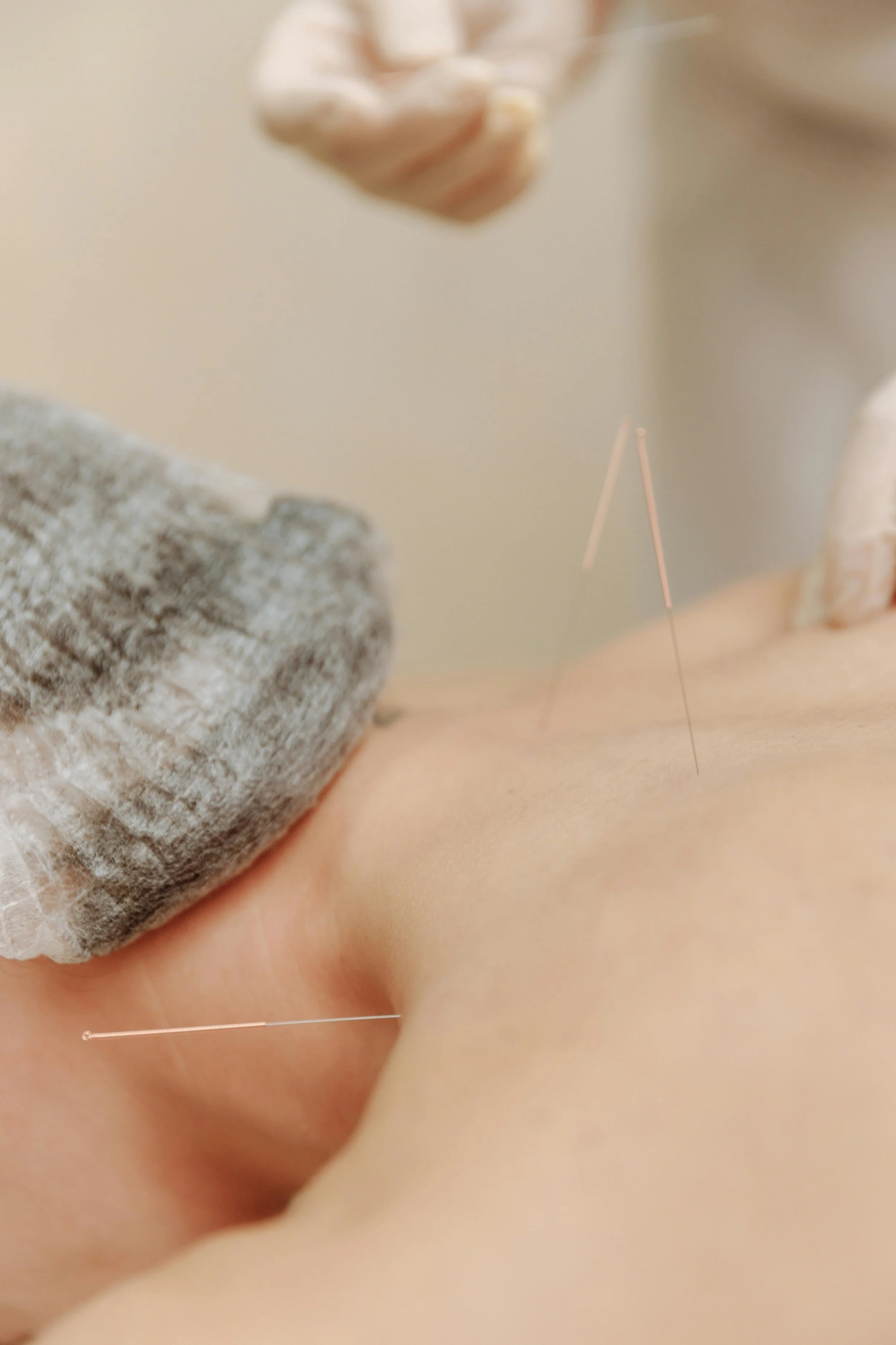 The Structural Approach: How Acupuncture Relieves Dysmenorrhea