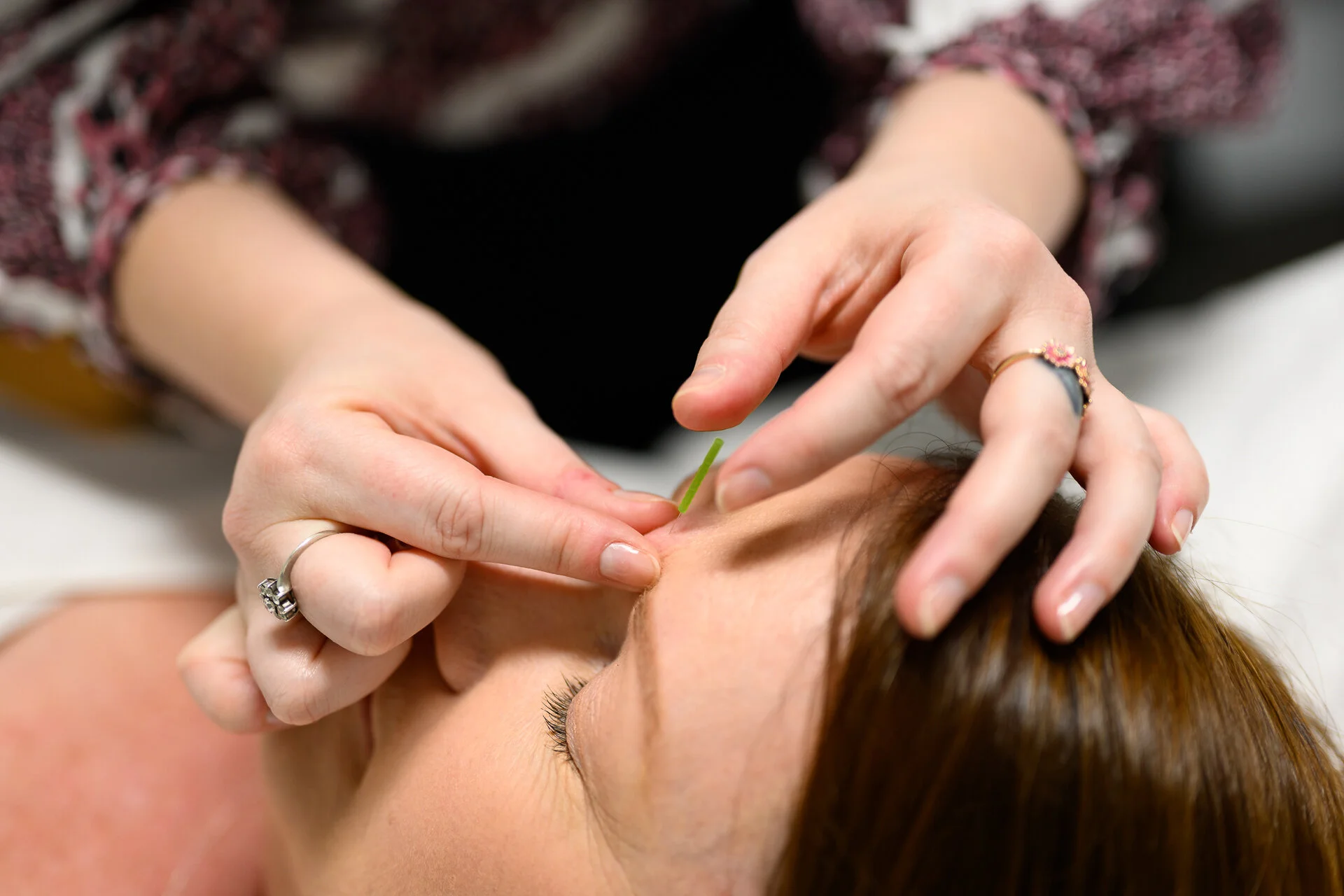 Acupuncture for Anxiety: How it Helps You De-Stress