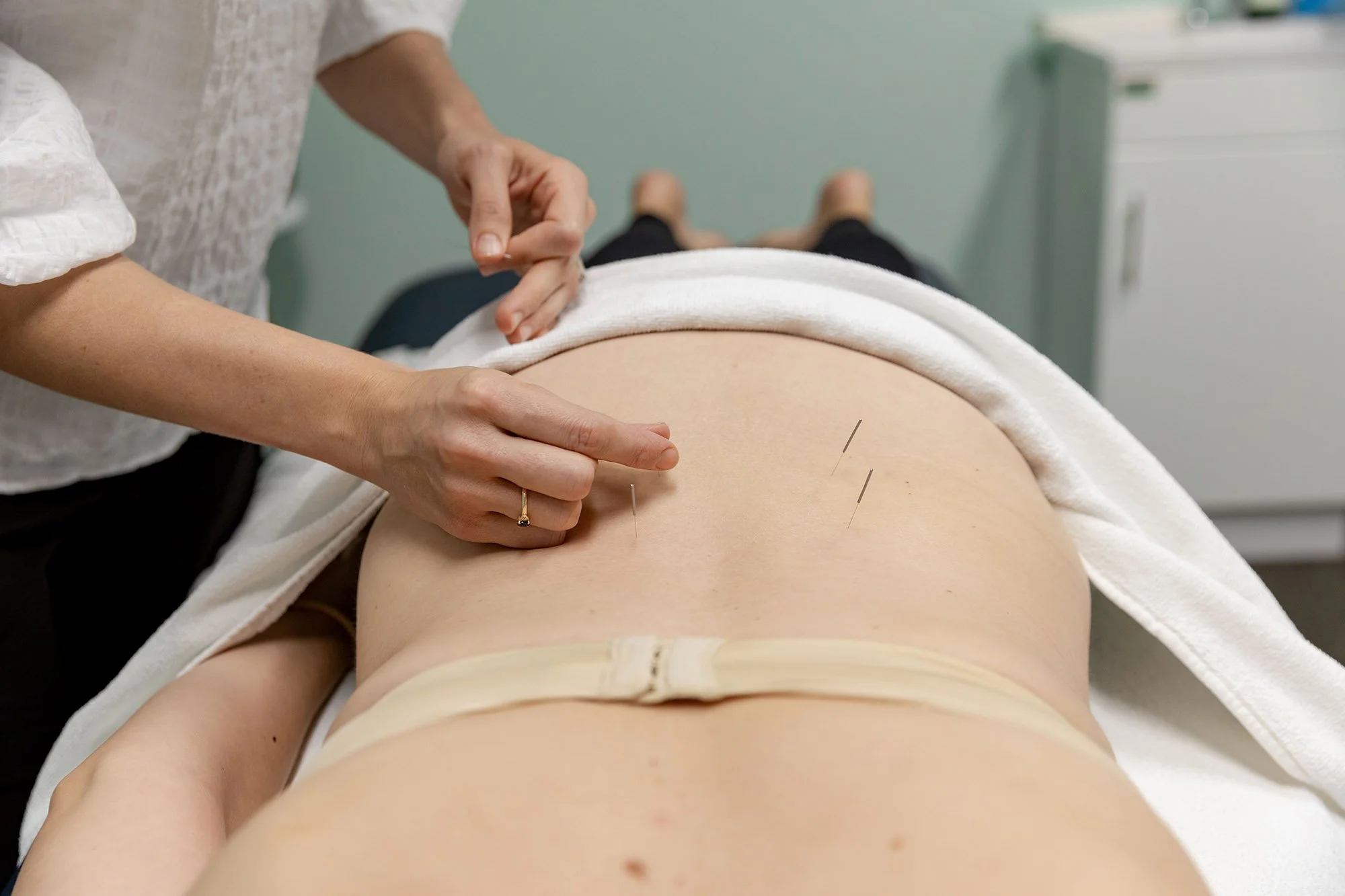 Pregnancy Acupuncture: Benefits for You and Your Bump 