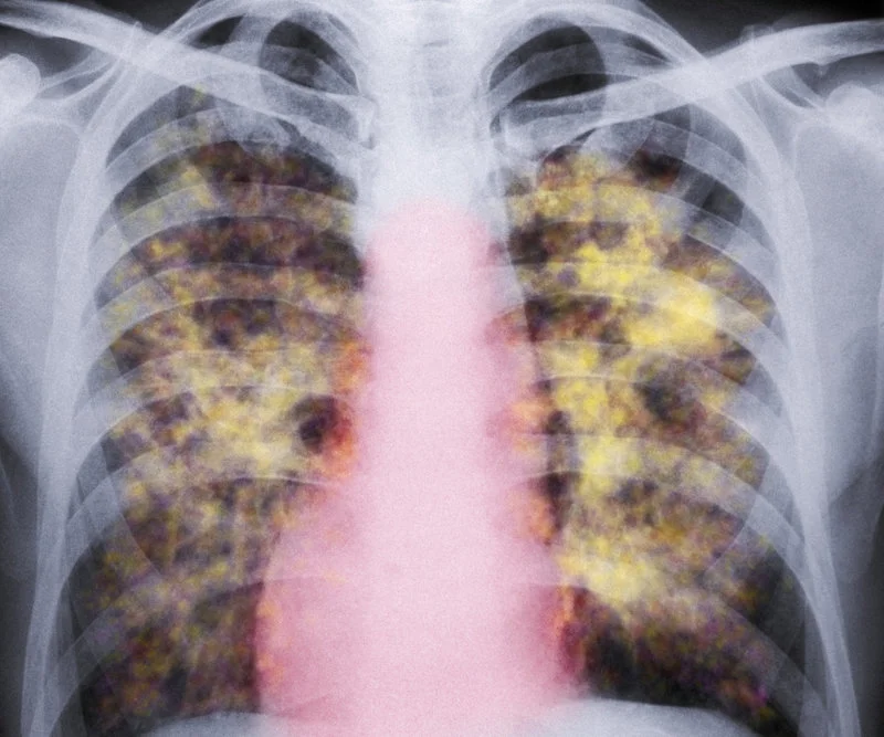 A colored X-ray of the lungs of a patient with silicosis, a type of pneumoconiosis. The yellow grainy masses in the lungs are areas of scarred tissue and inflammation.