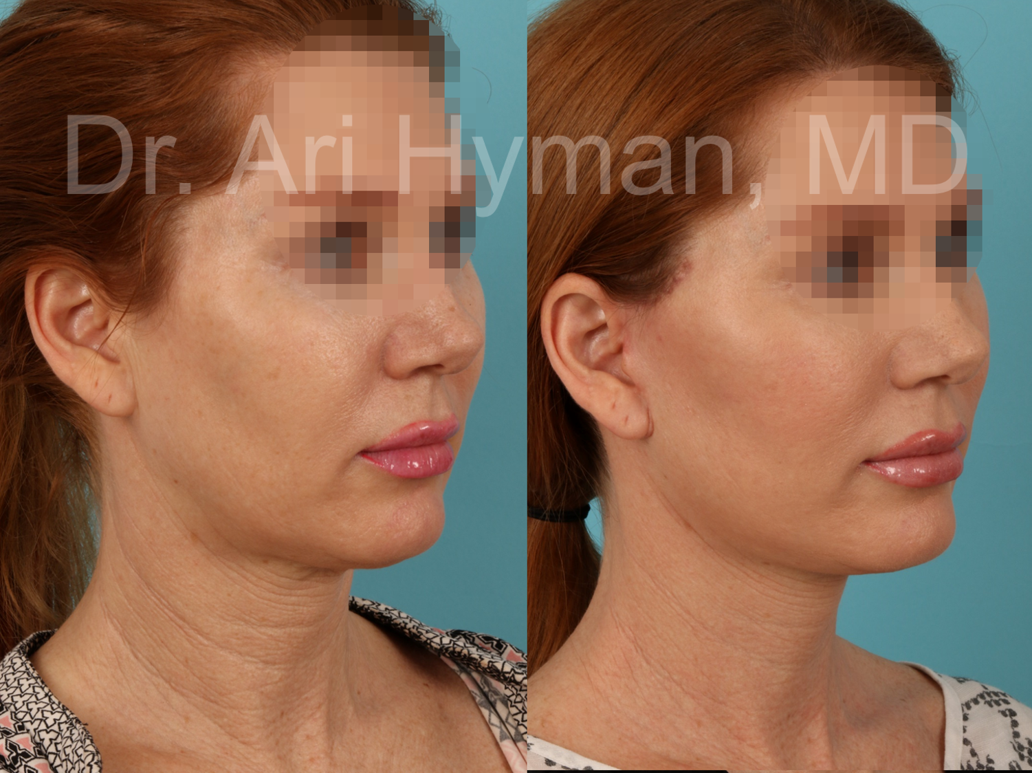 Facelift case 2