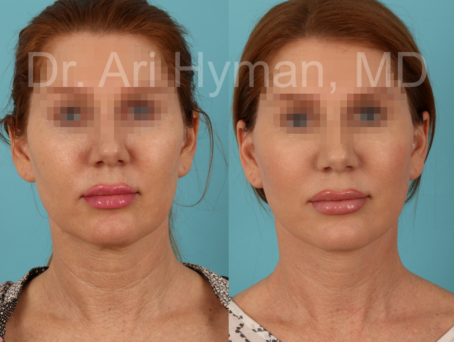 Facelift case 2
