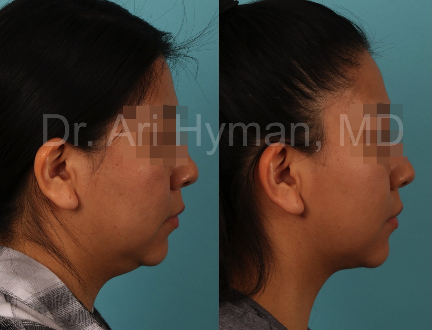 One month after submental liposuction performed in the office under local anesthesia