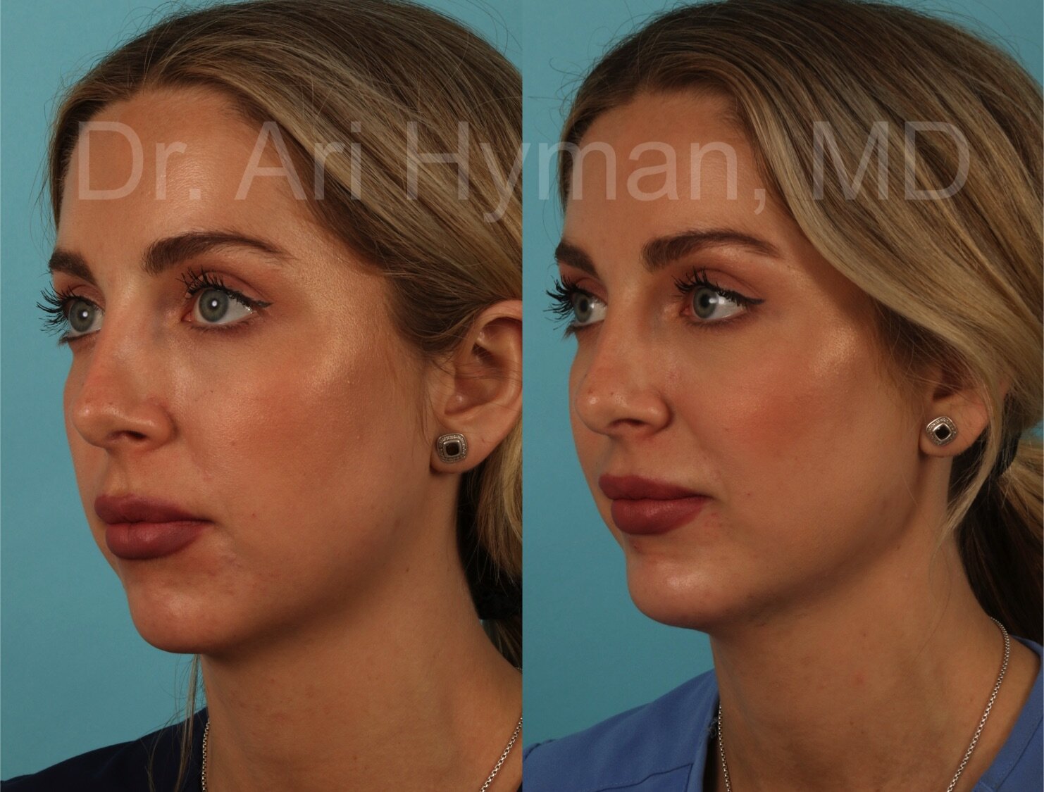 One month after chin implant performed in the office under local anesthesia.