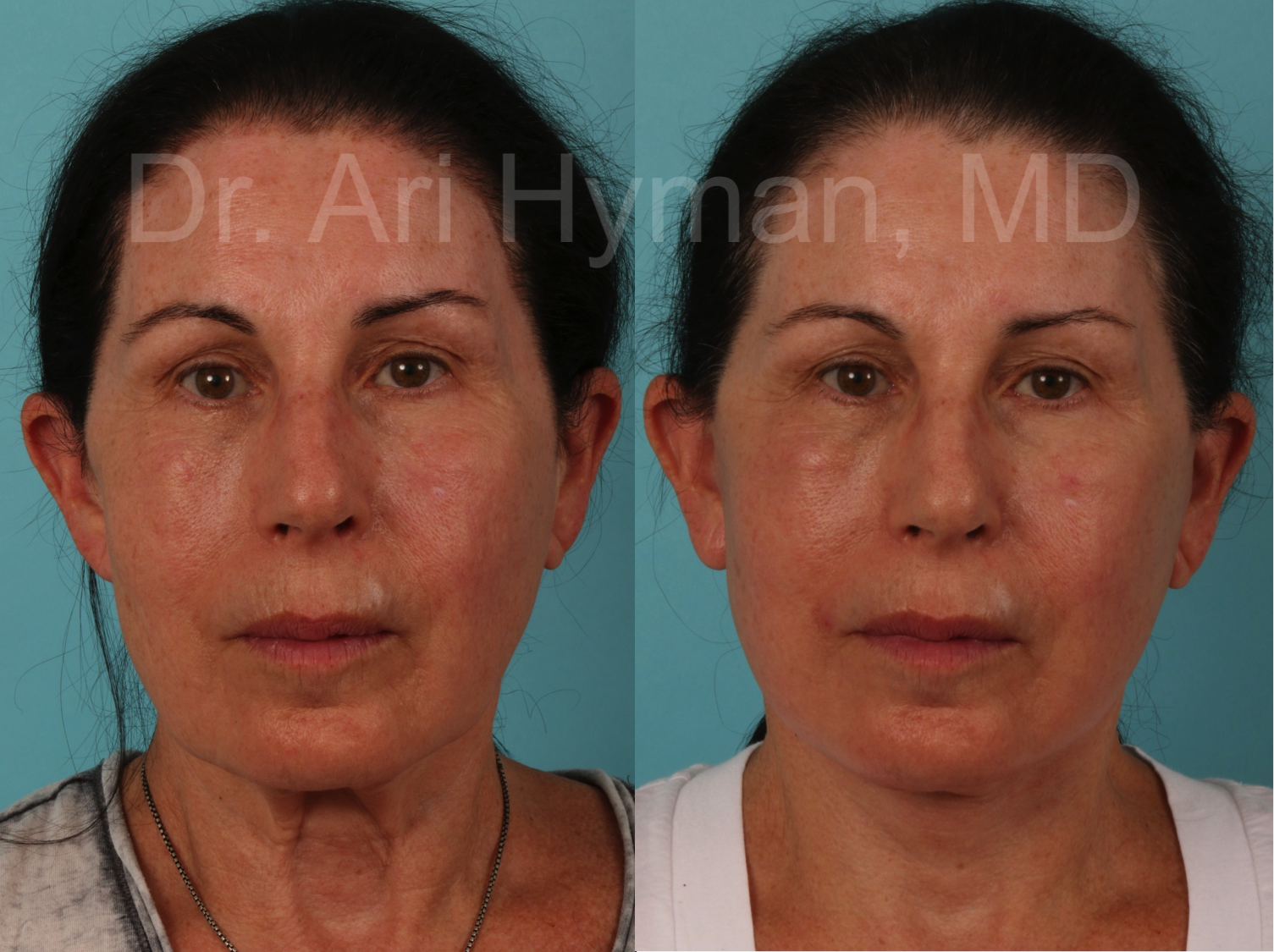 2 months after lower face and neck lift. 