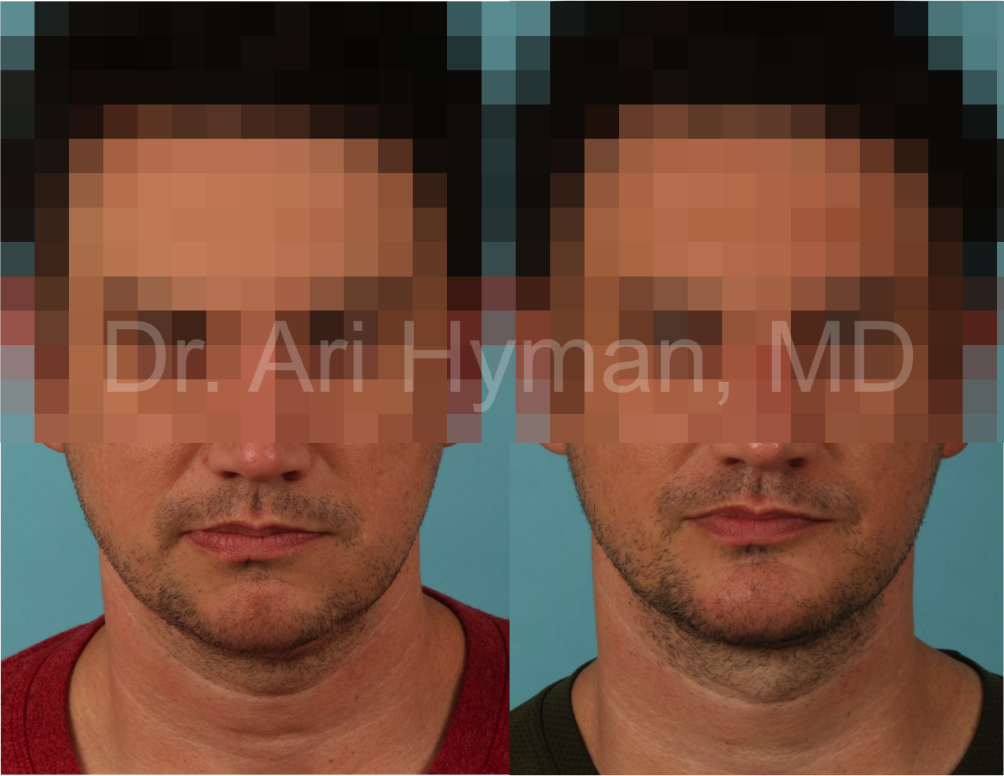 4 weeks after chin augmentation, neck liposuction, and neck muscle tightening performed in the office under local anesthesia.
