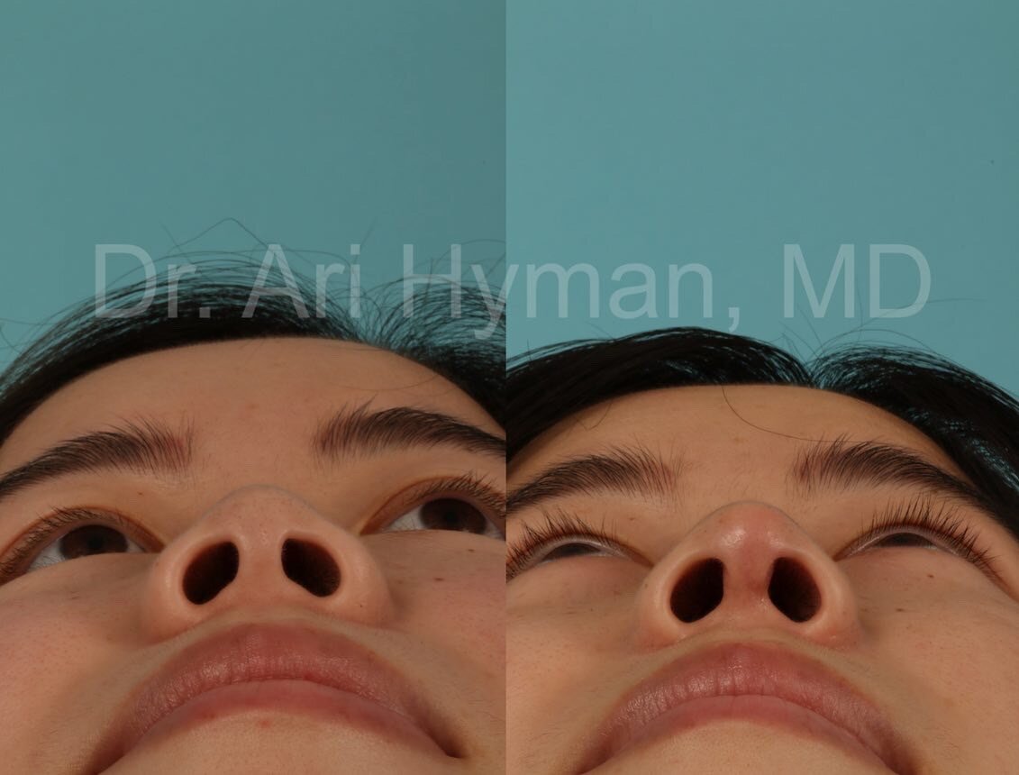 augmentation rhinoplasty - before and after view of woman's nose