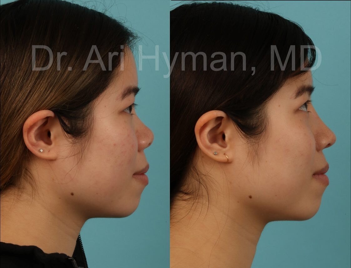 augmentation rhinoplasty - before and after view of woman's nose