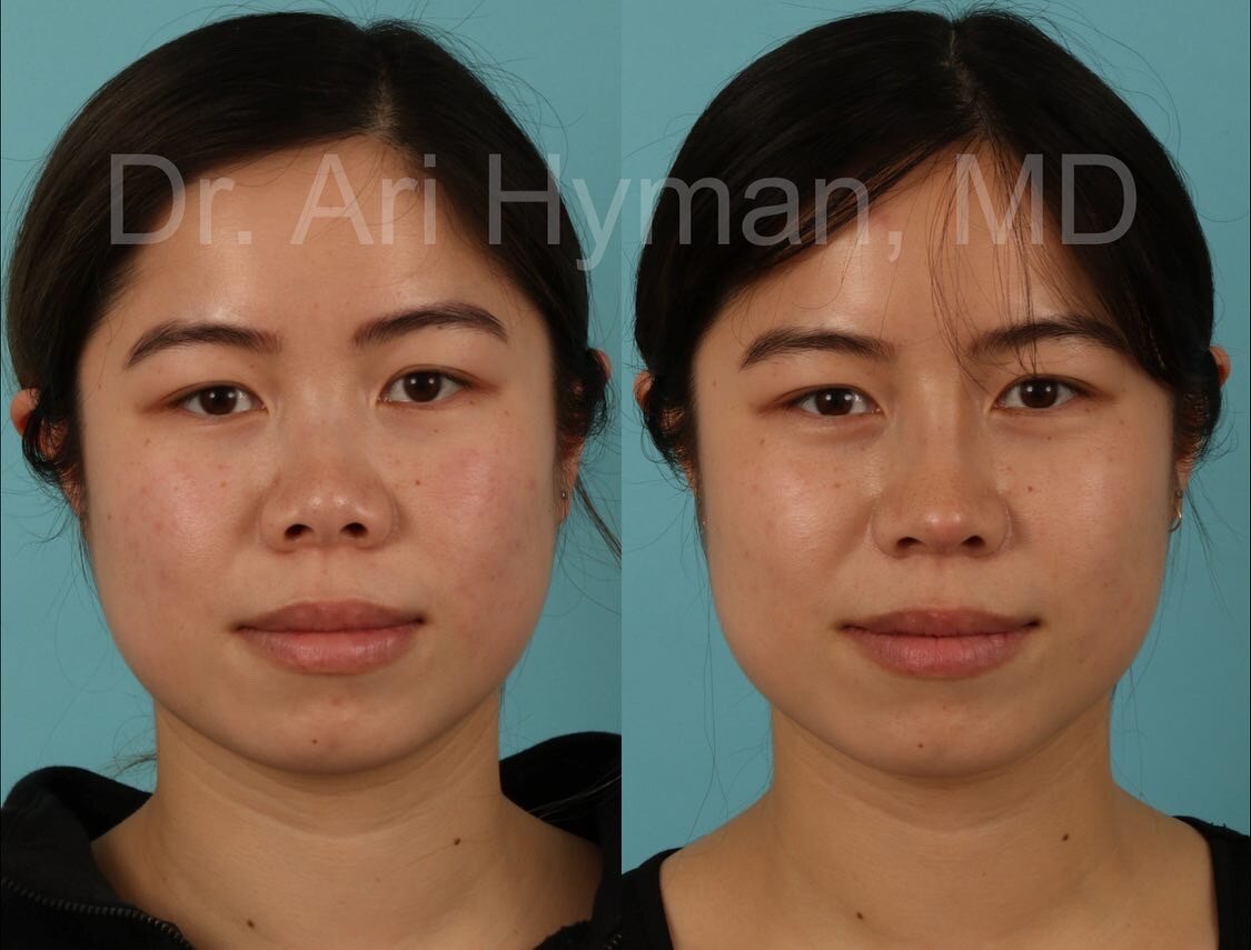 augmentation rhinoplasty - before and after view of woman's nose