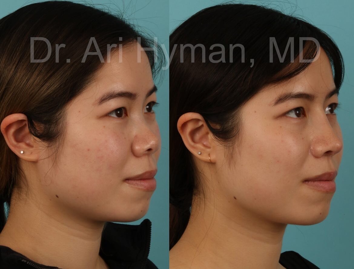 augmentation rhinoplasty - before and after view of woman's nose