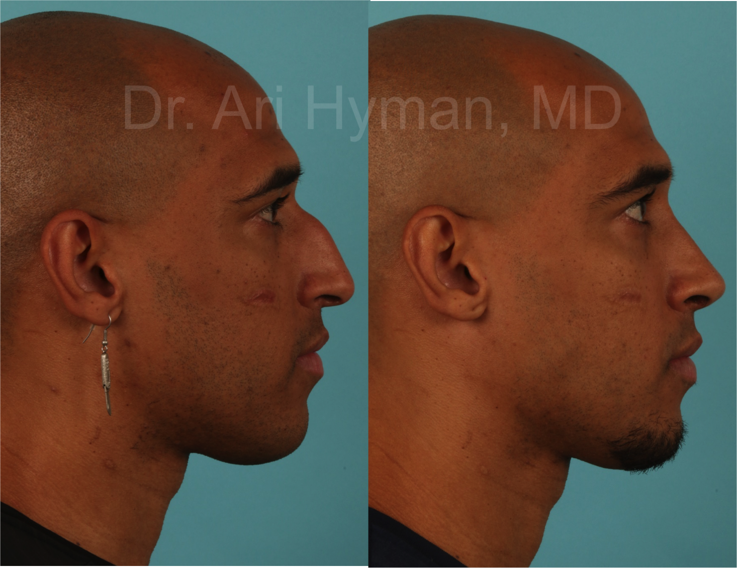 Rhinoplasty - before and after view of male's nose