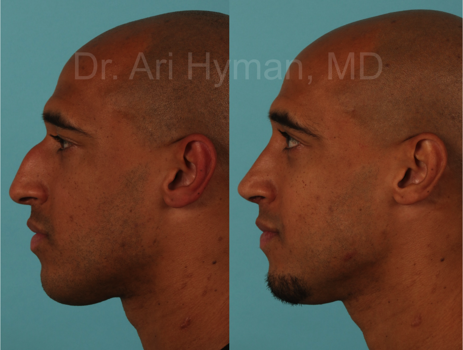 Rhinoplasty - before and after view of male's nose