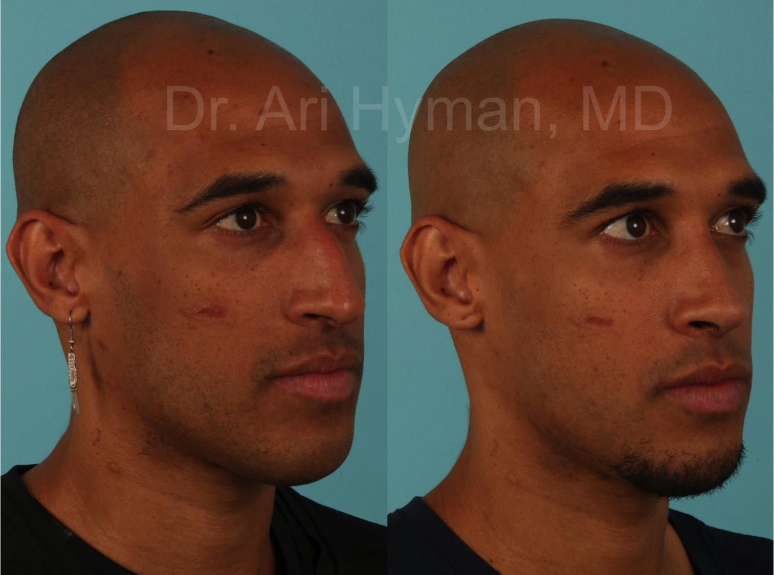 Rhinoplasty - before and after view of male's nose