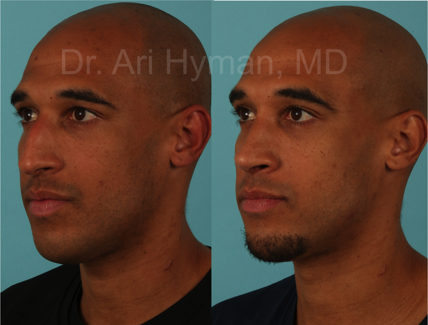 Rhinoplasty - before and after view of male's nose