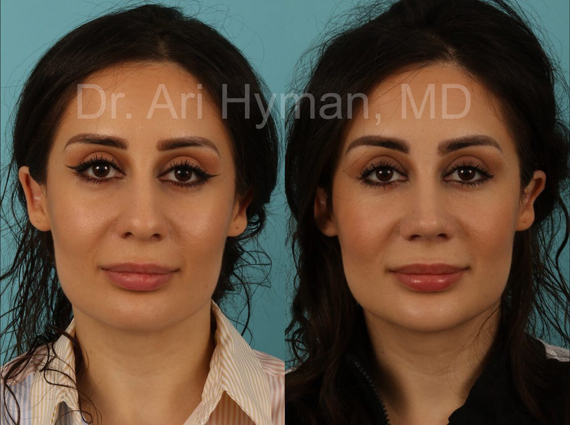 before and after view of woman's nose for rhinoplasty procedure