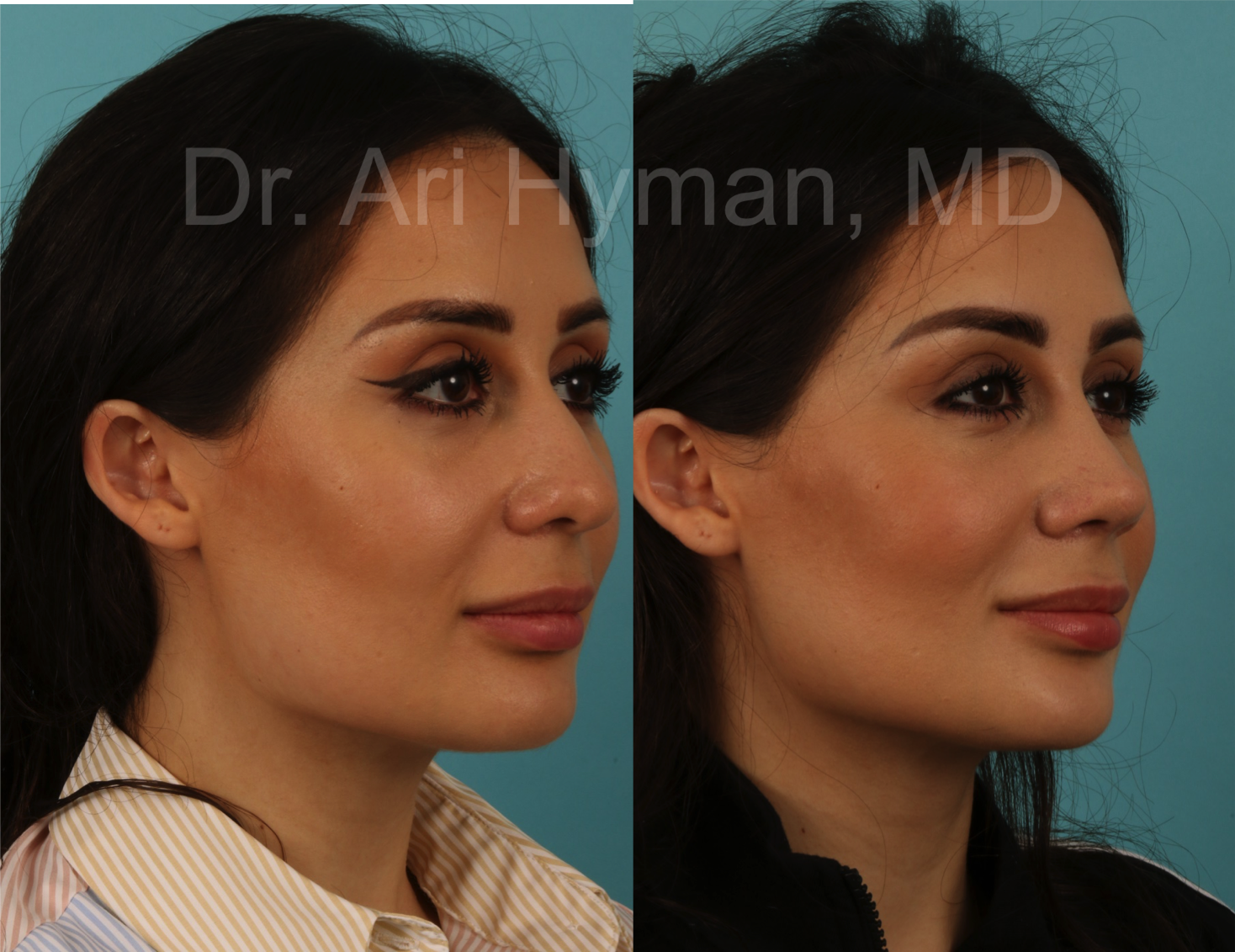 before and after view of woman's nose for rhinoplasty procedure