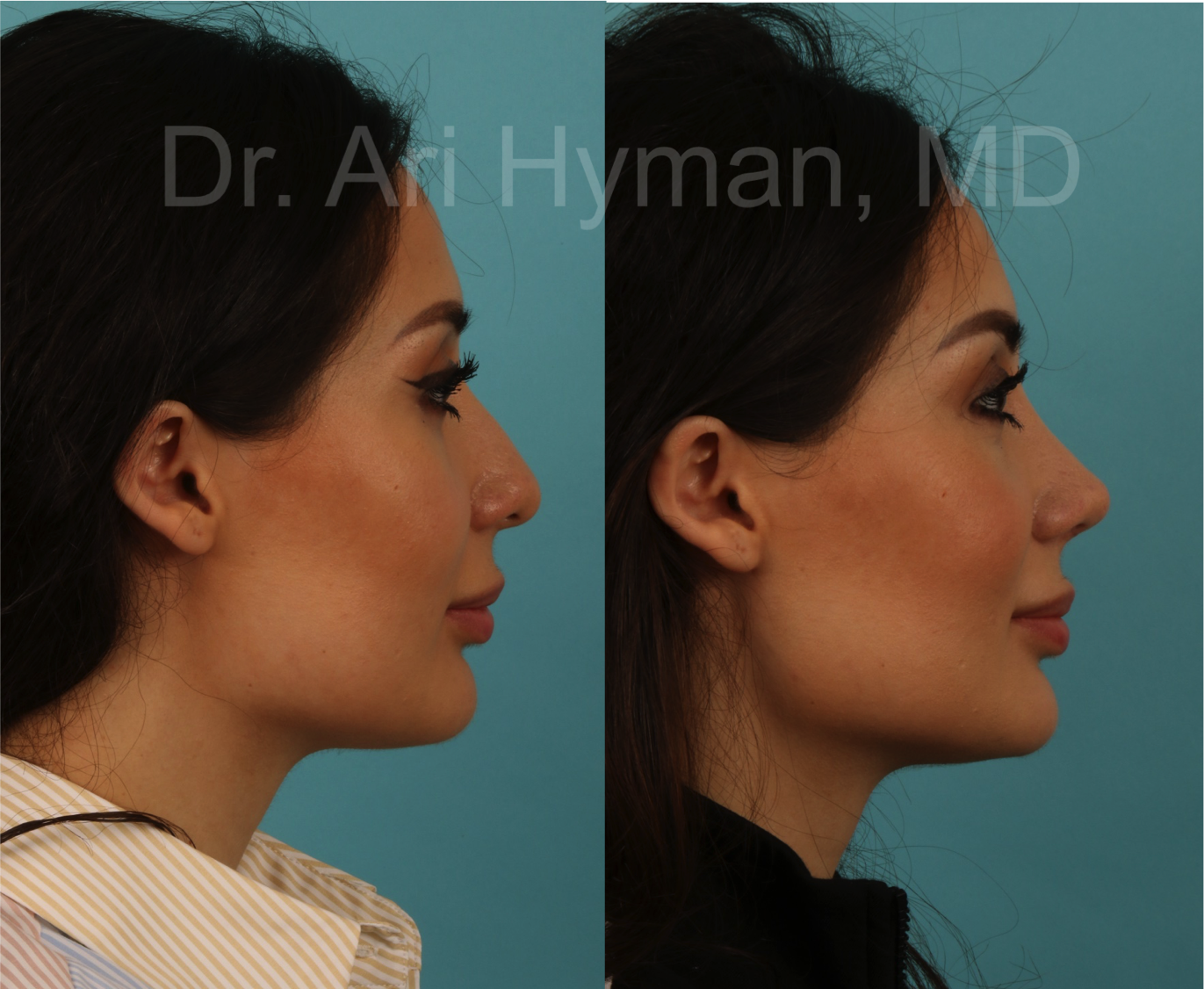 before and after view of woman's nose for rhinoplasty procedure