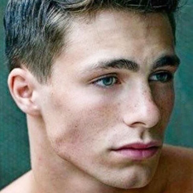 Lots of discussion today about male jawline contouring, mid-face fillers and fat transfer.  A male face is different than a female when it comes to contouring.  Sometimes less mid-face on a man is more in my personal opinion. Here is a young male fac