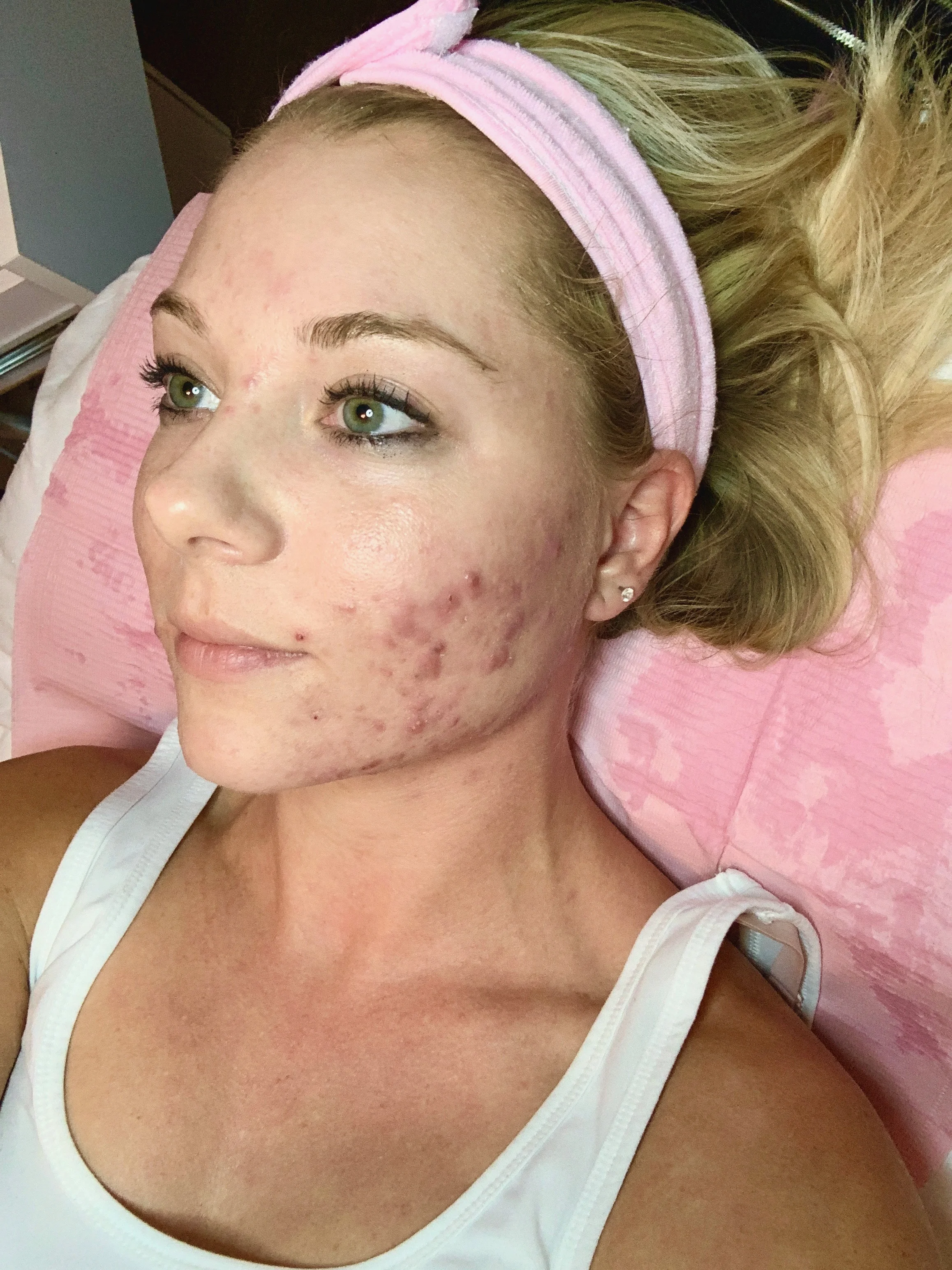Acne Story Part Two -- Treatment #1 