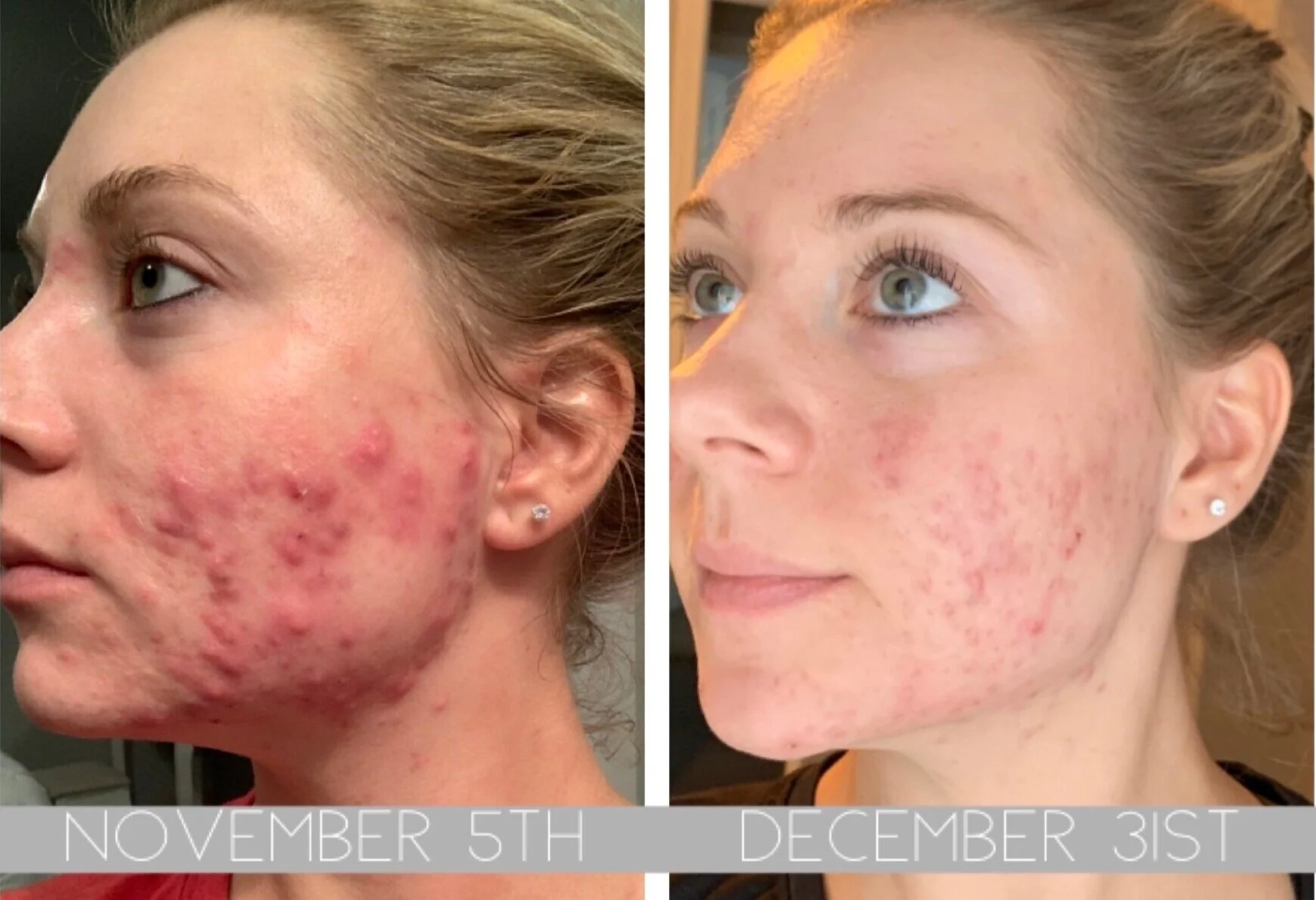 Accutane Before And After Cystic Acne