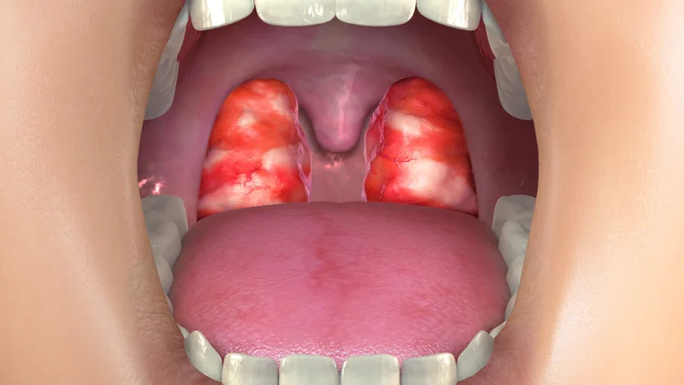 Tonsil and/or adenoid problems | doctorlansford.com