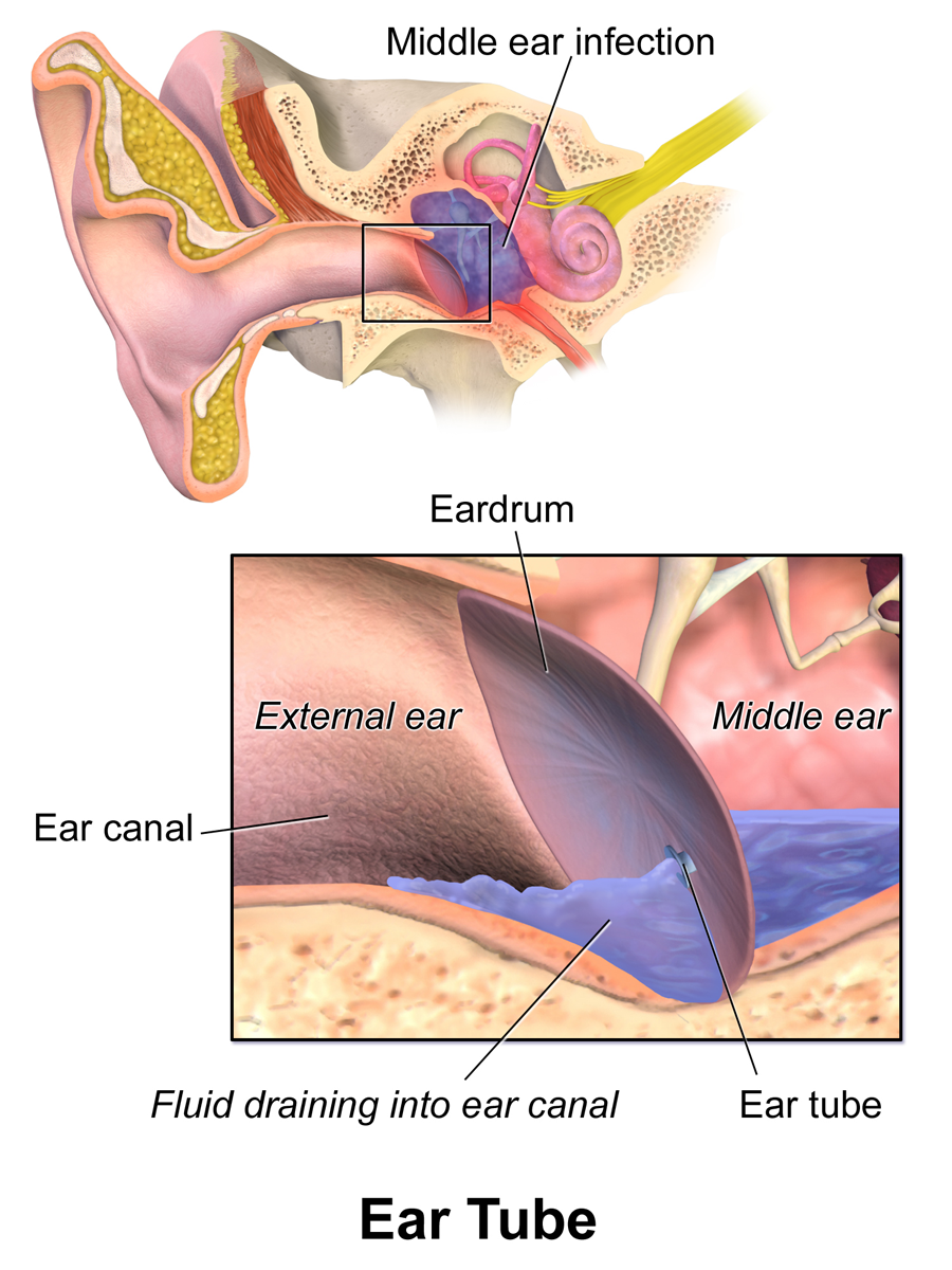 Tympanostomy Tube Placement Procedure Doctorlansford tympanostomy-tube-placement-procedure-doctorlansford