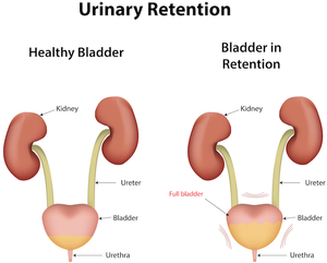 Urinary Retention After Surgery | doctorlansford.com