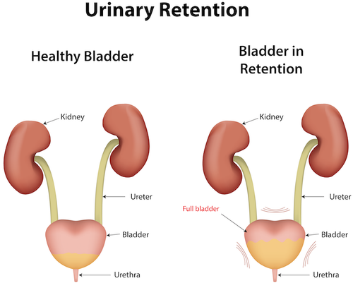 Urinary Retention After Surgery | doctorlansford.com