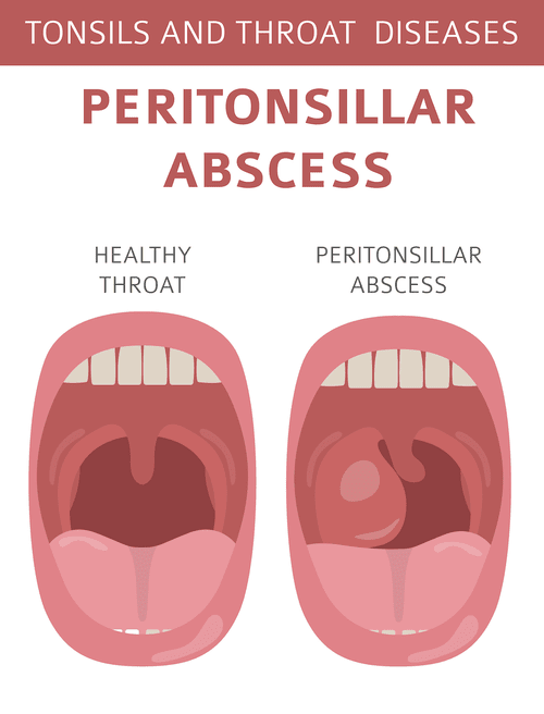 Tonsil Abscess and Peritonsillar Abscess | doctorlansford.com
