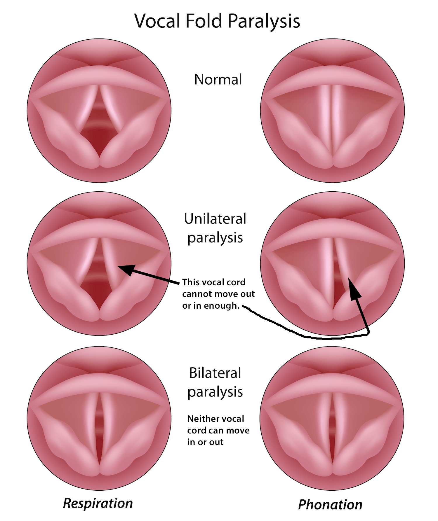 Laryngeal Nerve Dysfunction (Recurrent and Superior Laryngeal Nerves