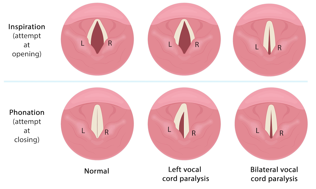 Voice Hyperfunction Laryngeal Nerve Dysfunction (Recurrent and Superior Laryngeal Nerves ...