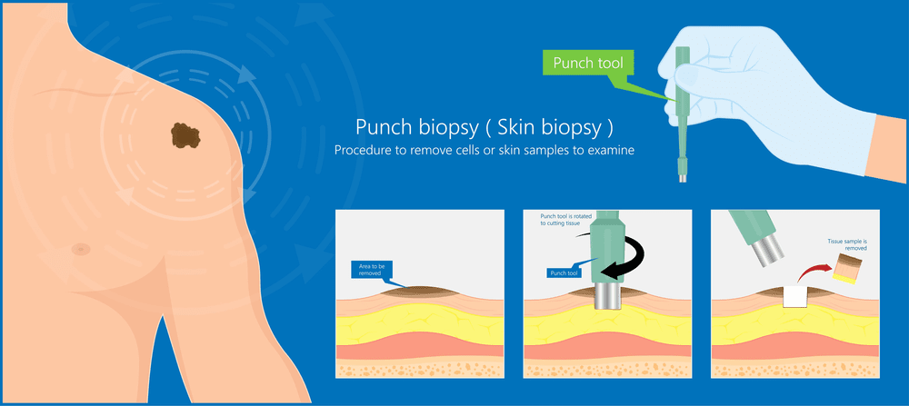 Punch Biopsy of Skin | doctorlansford.com