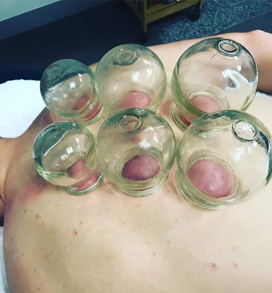 Cupping looks a lot more painful than it actually is for most people!