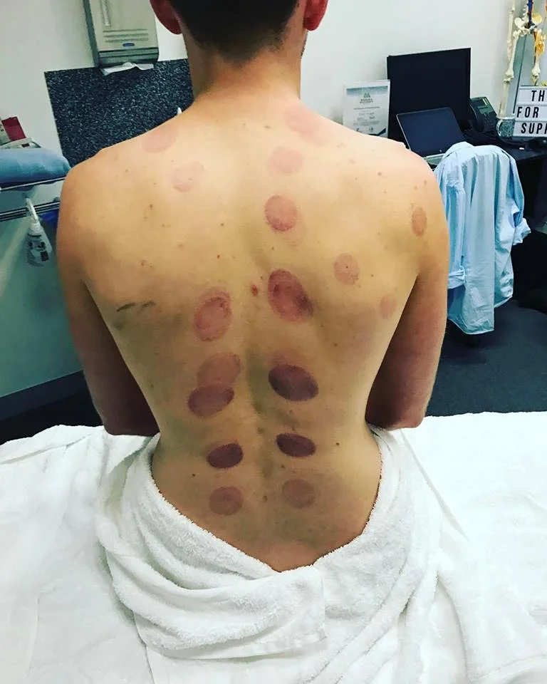 A tender sensation around cupping marks is another common post-treatment symptom