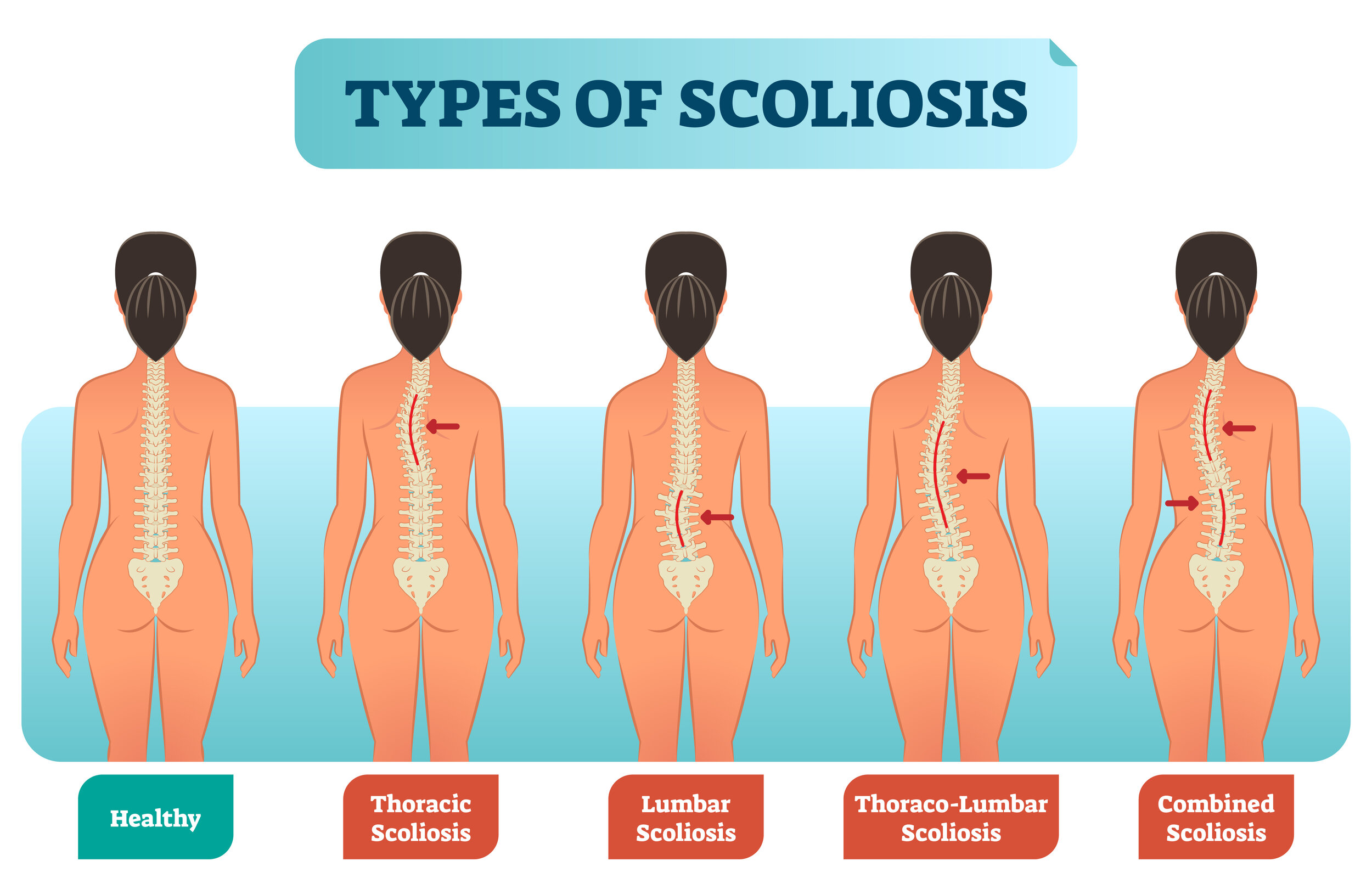 How Scoliosis Can Lead To Breath Shortness