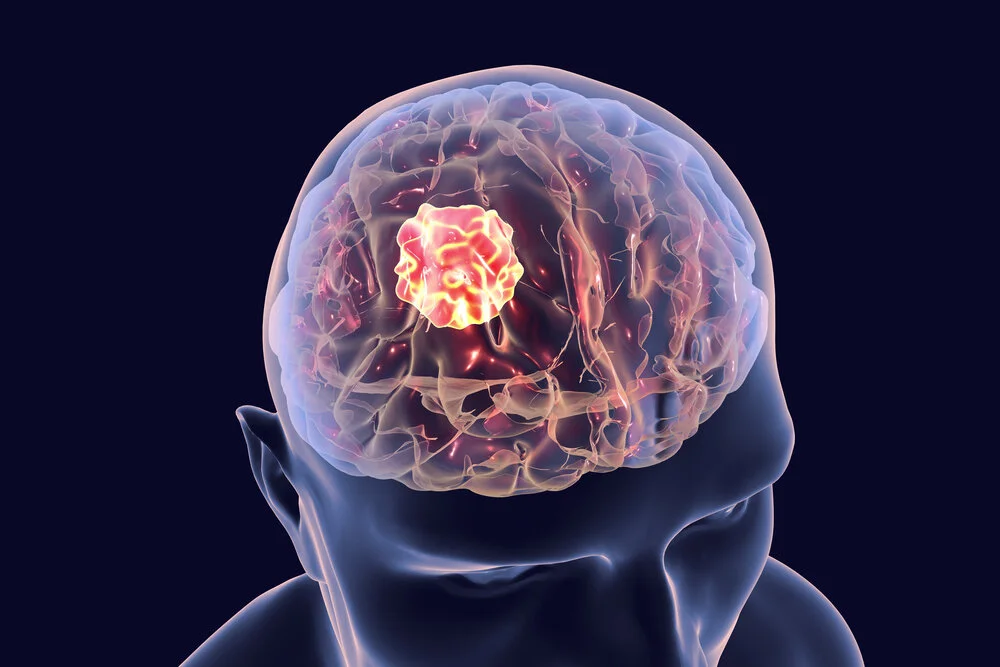 Common Facts about Brain Tumor You Must Not Miss