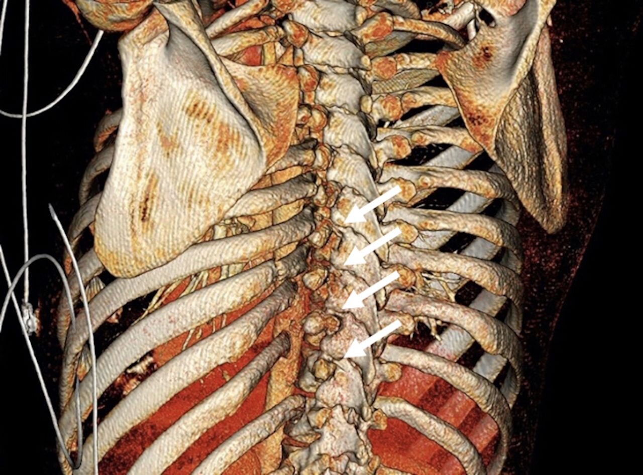 Strålende optager Vend om Injured ribs training Jiu Jitsu? The Complete Guide for the 5 Most Common  BJJ Rib Injuries — Momentum WOD