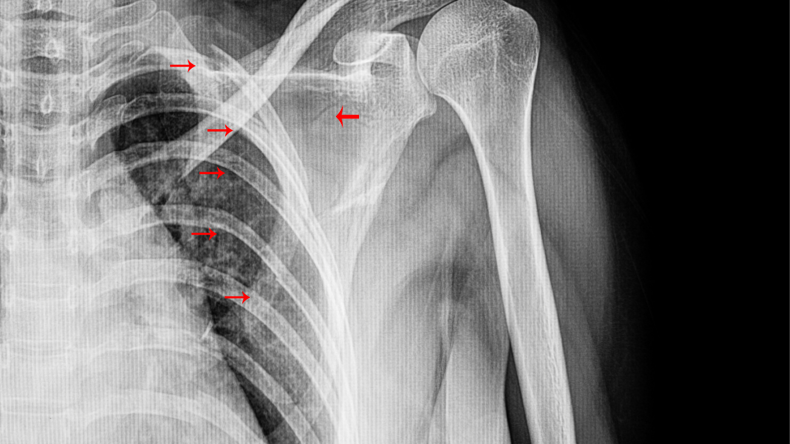 False Broken Ribs
