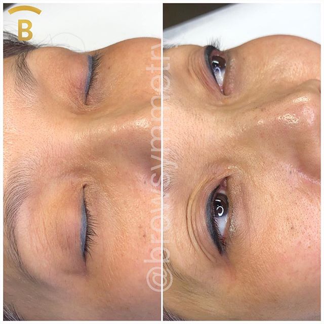 Covered up an old eyeliner tattoo that had turned blueish grey. . .
.
.
.
#beforeandafter #wakeupwithmakeup #summergoals #waterproof #sweatproof #microblading #powderombrebrows #eyeliner #southbay #losangeles #longbeach #redondobeach #orangecounty  #