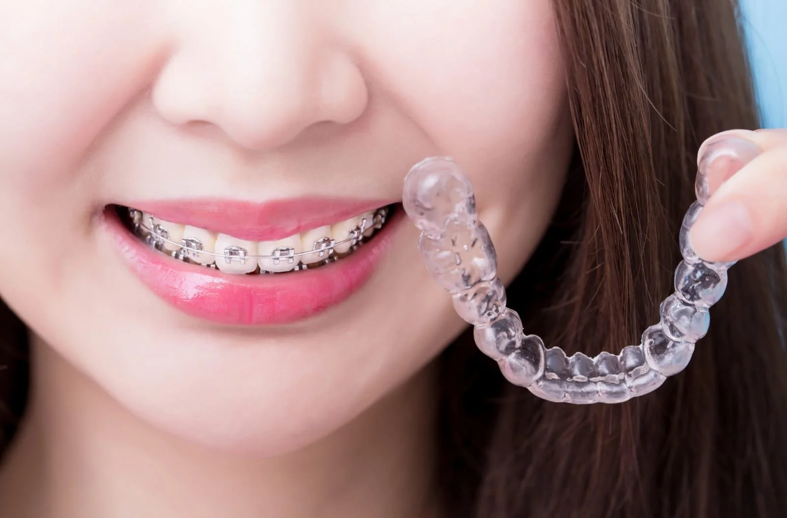 Invisalign vs. Traditional Braces: Which is Right for You?