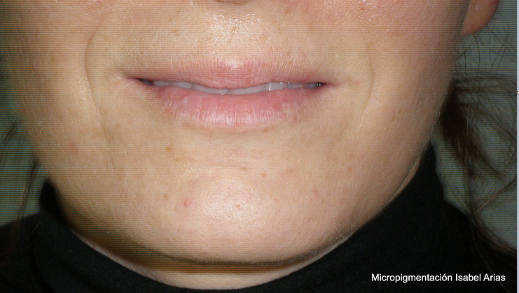 labios++a)+-+labio+con+poca+pigmentación+y+contornos+poco+definidos.png